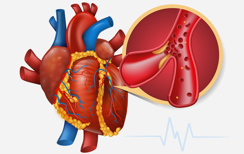 الشريان التاجي ونقص التروية 1 coronary artery disease treatment in Dubai - علاج مرض الشريان التاجي