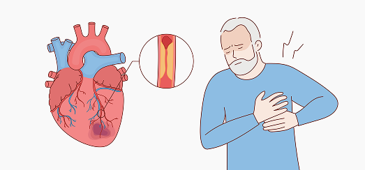 الشريان التاجي ونقص التروية 2 coronary artery disease symptoms, ischemic heart disease