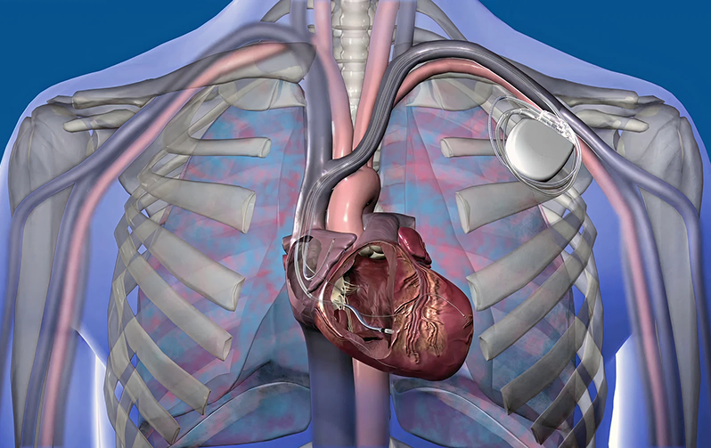 إعادة تزامن القلب CRT 1 crt therapy in Dubai, crt meaning