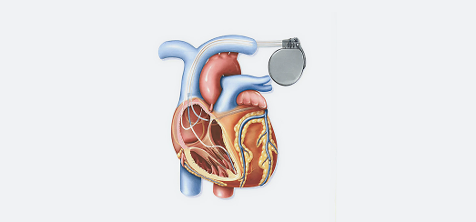 إعادة تزامن القلب CRT 2 what is crt, crt stand for, crt pacemaker, crt defibrillator - علاج إعادة تزامن القلب