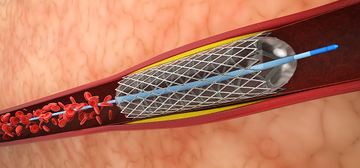 Angioplasty in Dubai 1 angioplasty in Dubai, coronary angioplasty in Dubai, angioplasty procedure in Dubai