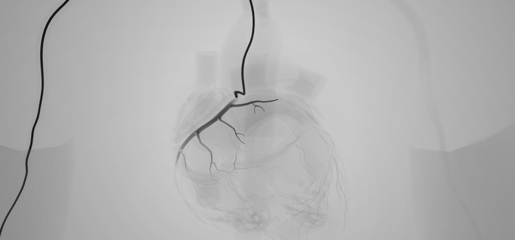 Coronary angiography in Dubai, Heart angiography in Dubai, Angiography cost in Dubai, Angiography procedure in Dubai