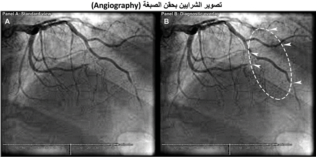 تصوير الشرايين بحقنة الصبغة