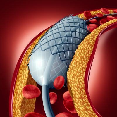 دعامة القلب