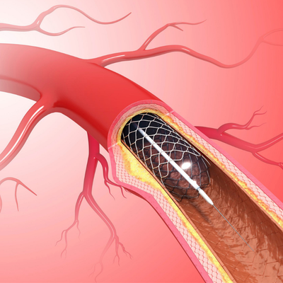 كم تستغرق عملية قسطرة القلب