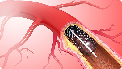 Coronary Angioplasty in dubai